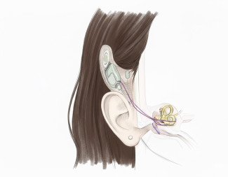 Seitliche medizinische Illustration eines menschlichen Ohrs mit einem Cochlea-Implantat. Das Implantat besteht aus einem hinter dem Ohr platzierten Gehäuse mit einer Antenne, die durch die Haut führt, und einer dünnen Elektrode, die in die Cochlea (Innenohr) eingeführt ist. Die Illustration zeigt die anatomischen Strukturen des Ohrs, einschließlich Außenohr, Gehörgang, Trommelfell, Mittelohr und Innenohr in gelber Farbe. Die Haare sind braun dargestellt.